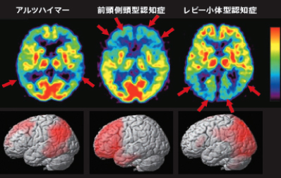 レビー小体型認知症の血流パターンの比較