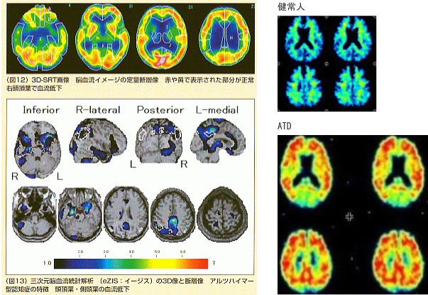 レビー小体型認知症の血流パターンの比較